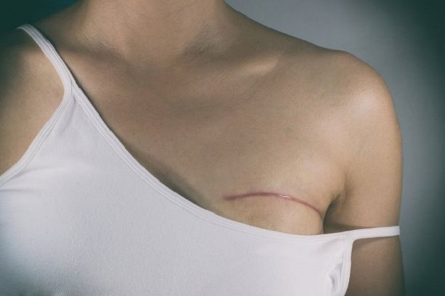 Prótese de silicone: opção para quem passa pela cirurgia de retirada da mama